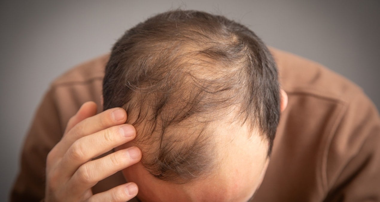 Erkeklerde Saç Dökülmesine Yol Açan İçecekler Belirlendi